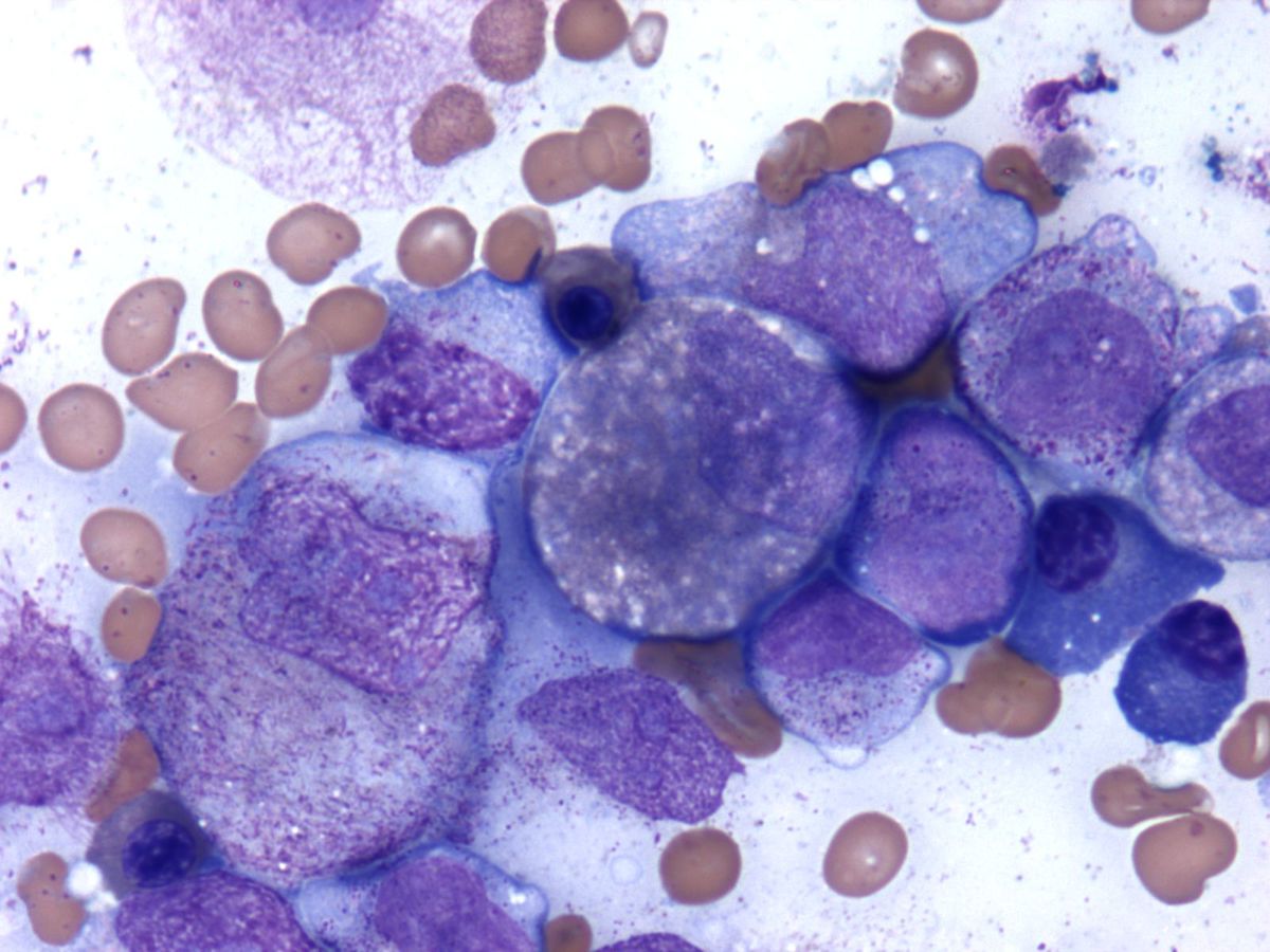 bone marrow aspirate smear 1000x 